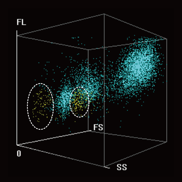 BC-7600 Series Auto Hematology Analyzers - Typical samples of acute monocytic leukemia (M5)