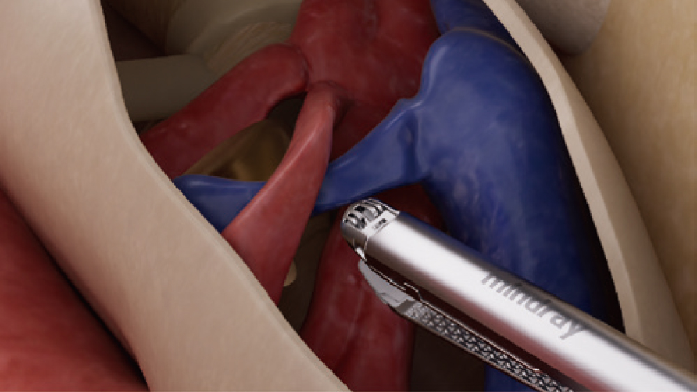 Articulating Endoscopic Linear Cutter and reloads - Detachable Curved Tip