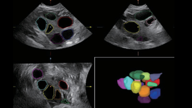 Smart FLC 卵泡自动丈量