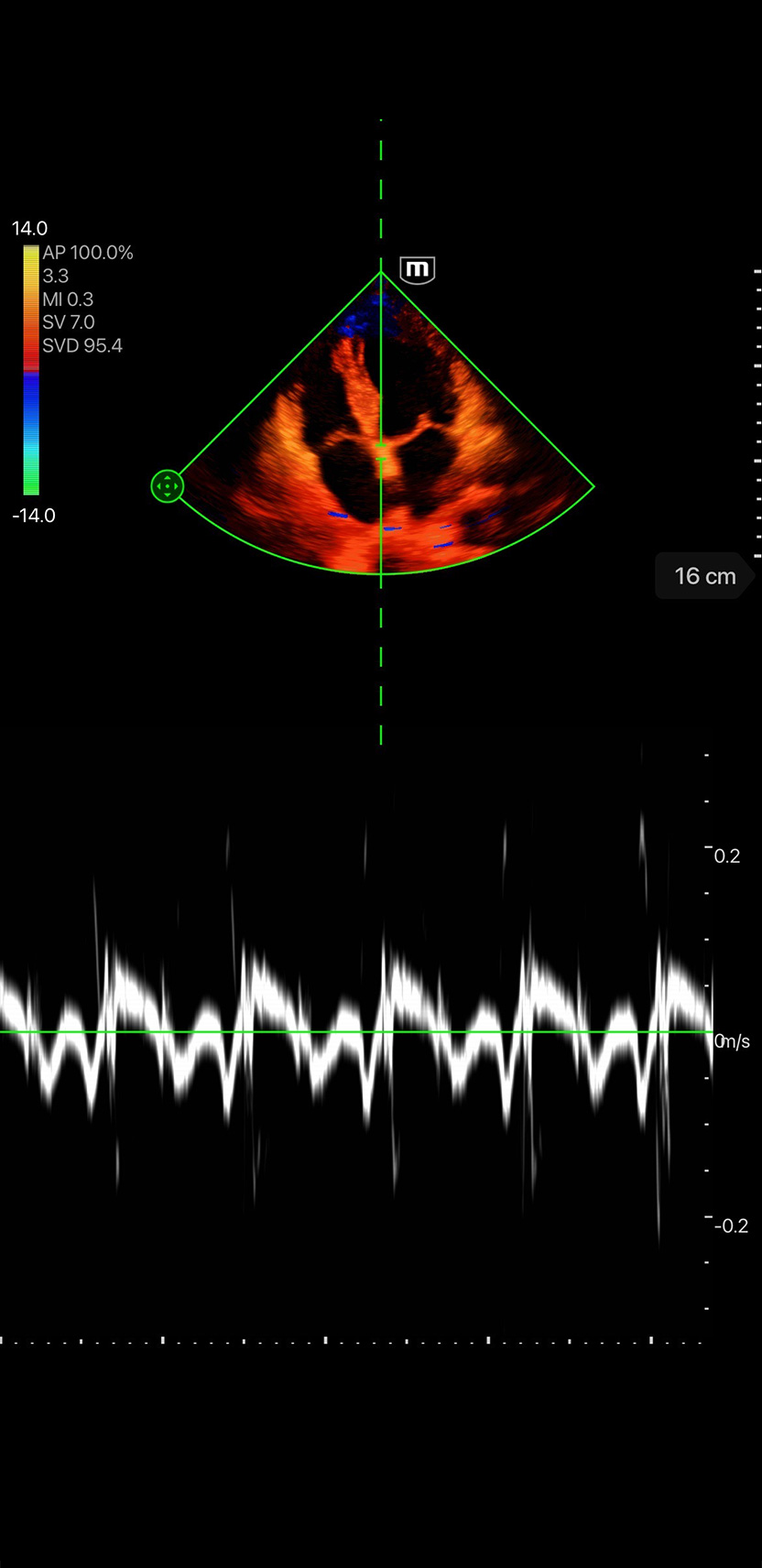 Doppler della velocità tissutale
