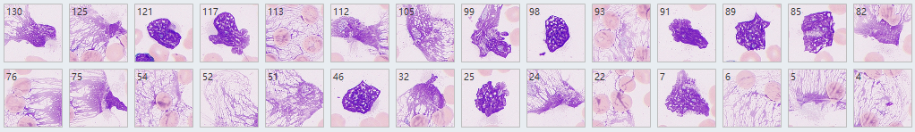 Smudge cells peripheral blood film