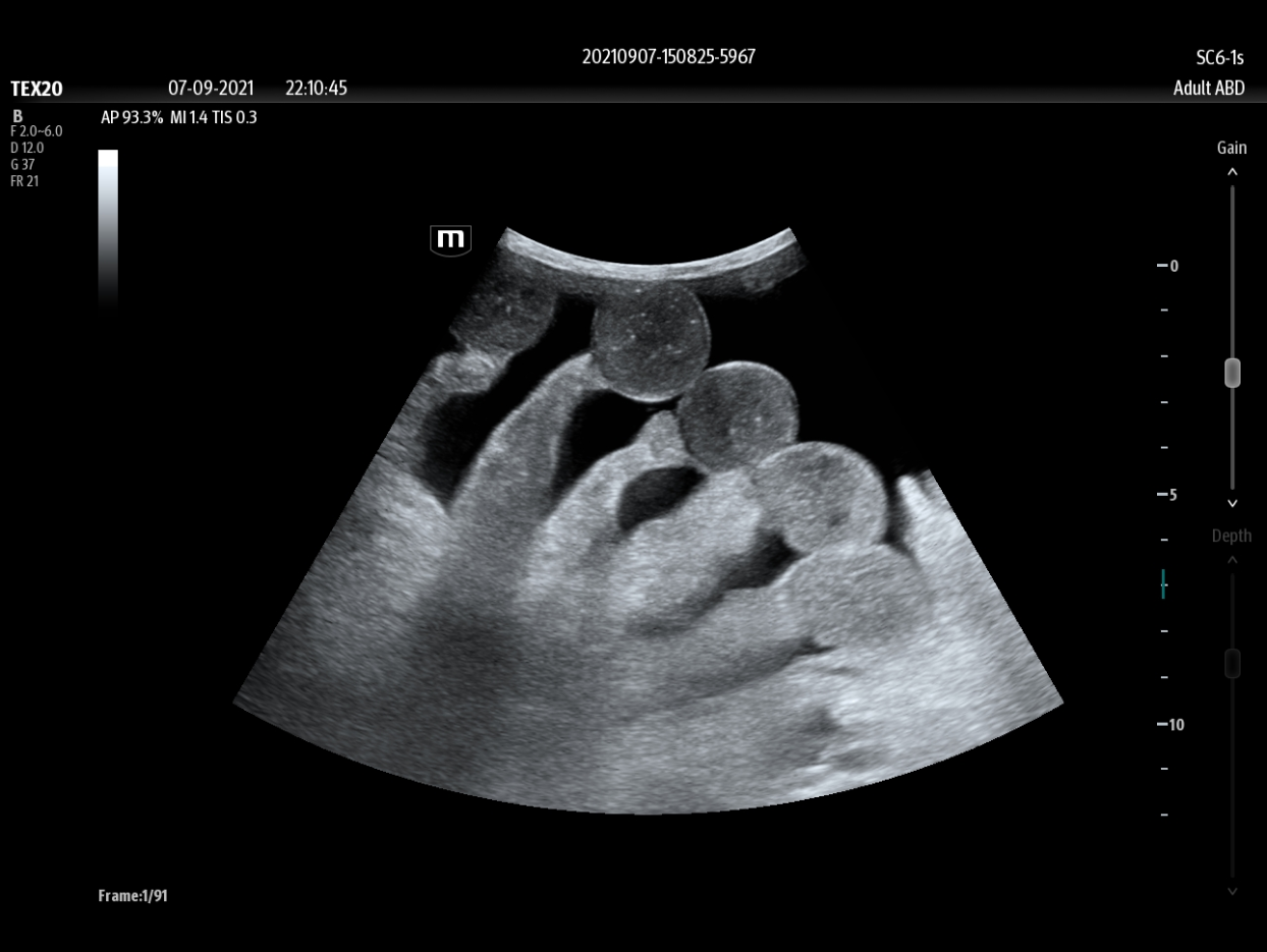 SC6-1s_Ascites_2-1244x935