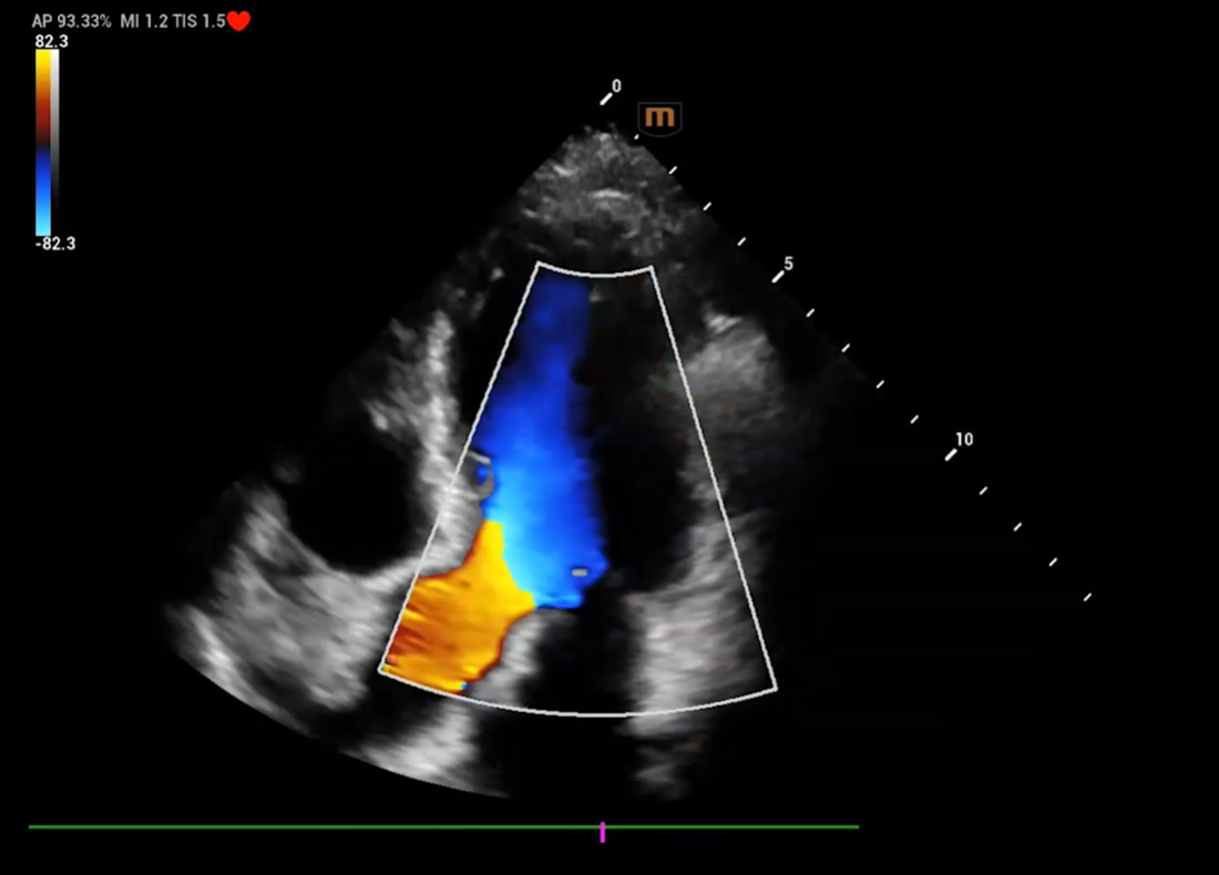 Recho R9 Cardiac Structure and Color Doppler lmaging - Aortic regurgitation image