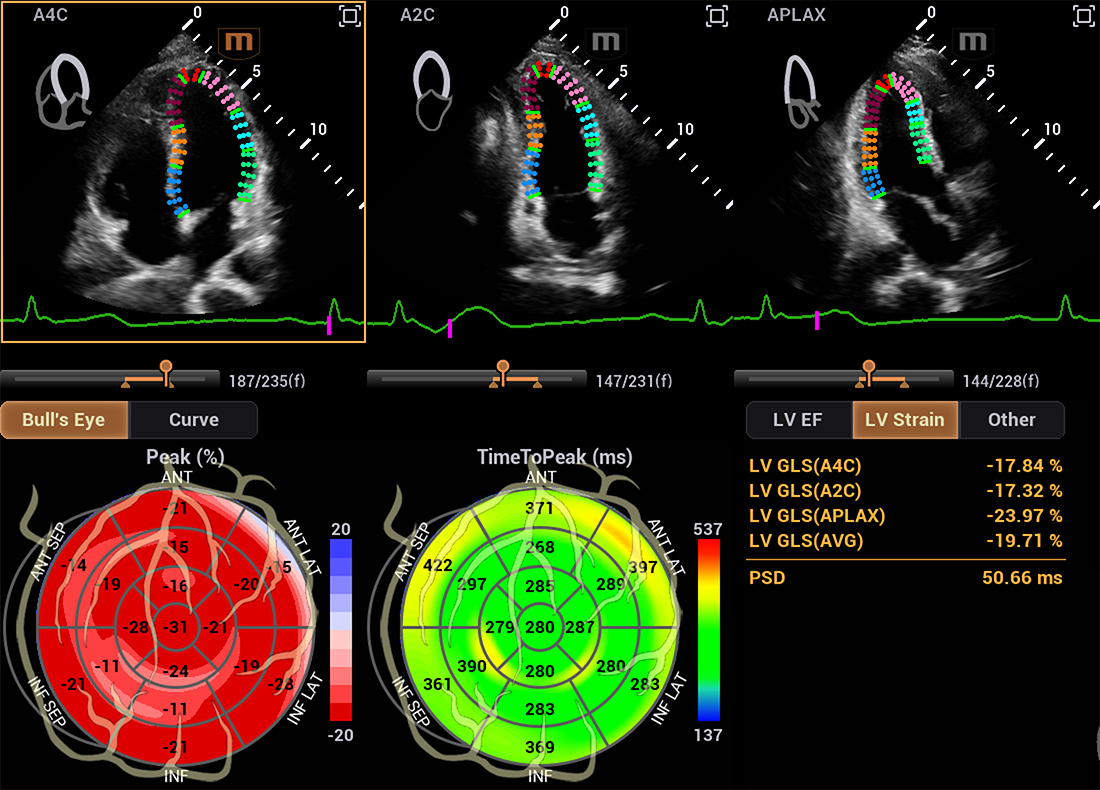 Recho R9 Automated Cardiac Function Analysis - Auto Strain LV image
