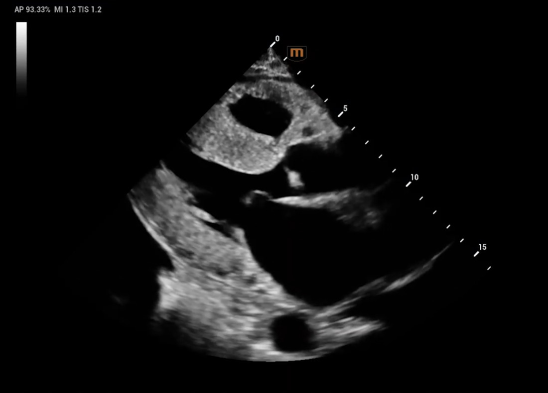 Recho R9 Cardiac Structure and Color Doppler lmaging - Cardiac Amyloidosis image