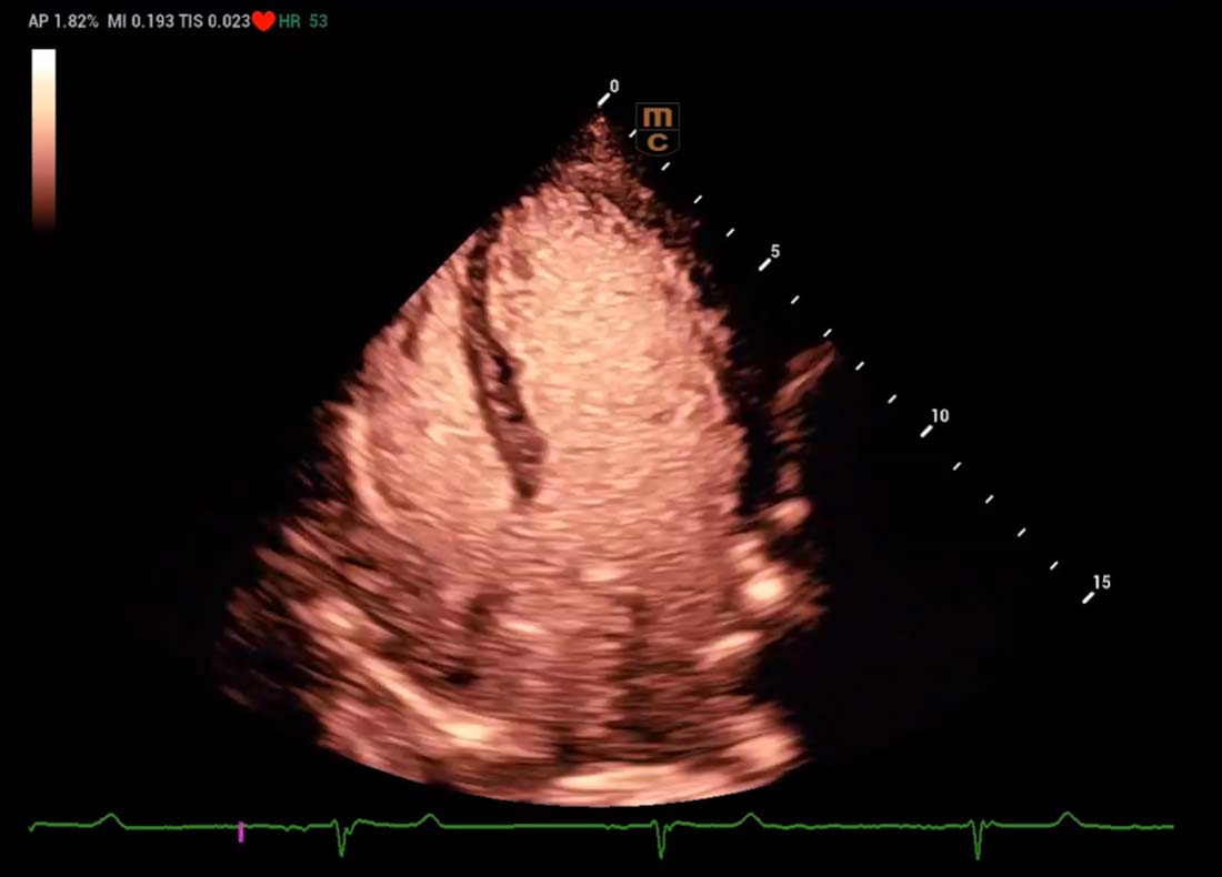 Recho R9 Contrast-enhanced Echocardiography - VLMI Contrast image