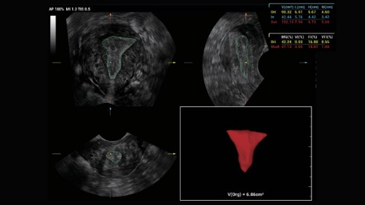 子宫内膜自动丈量