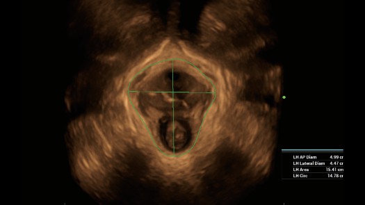 自动盆底超声解决计划