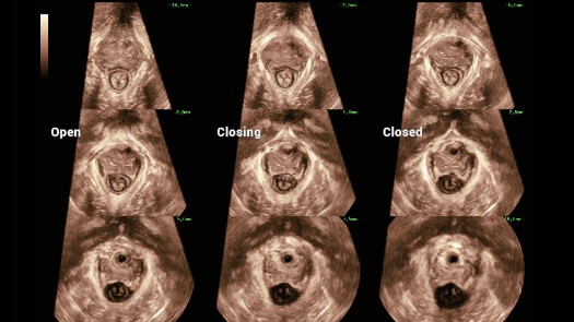 自动盆底超声解决计划