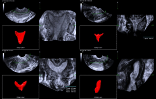 Ultrasound Journal 33 - Use of Smart ERA in diagnosis of Müllerian duct abnormalities
