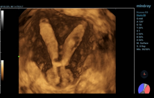 Ultrasound Journal 39 - Ultrasonic Diagnosis of Müllerian Duct Anomalies