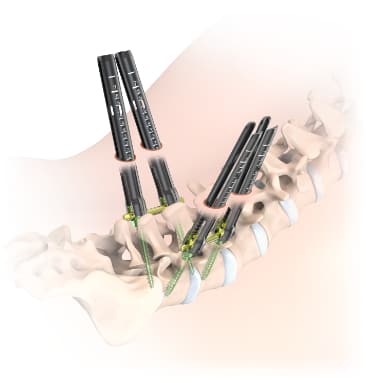 MS MIS Posterior Pedicle Screw System (Cemented)