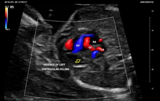 Ultrasound Journal 36 - Detection of Hypoplastic Left Ventricular Syndrome in Second-Trimester Ultrasound Screening