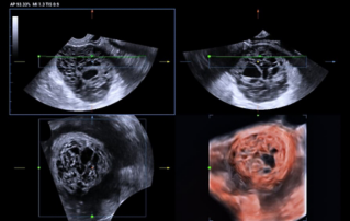 Ultrasound Journal 34 - Use of IOTA-ADNEX & O-RADS risk assessment models in MDT management of Adult Granulosa Cell Tumor 