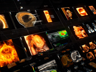 超声智能应用，，，，，让更多女性享有高质高效的超声诊断